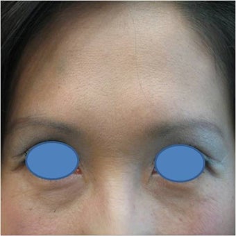 Botox after 83024