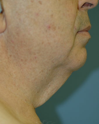 Neck Lift before 537398