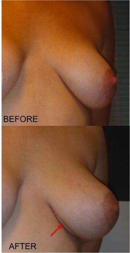 LSGAP "Love Handle" Flap Breast Reconstruction after 416806