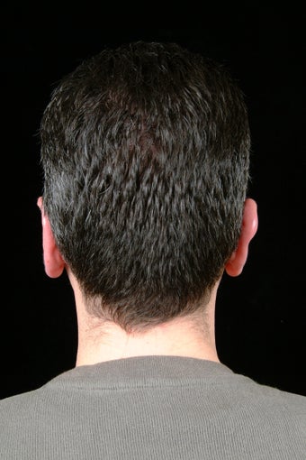 Ear Pinning 323699