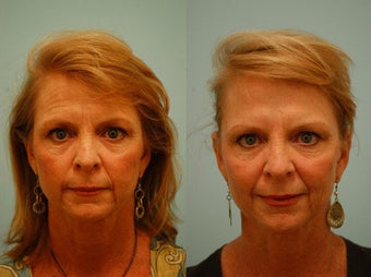 Botox before 138514