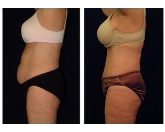 Tummy Tuck / Abdominoplasty before 54971
