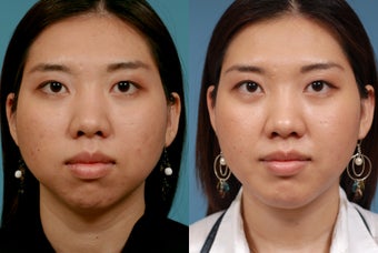 Chin Augmentation after 409091