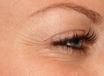 Dysport injections for Crow's Feet before 119752