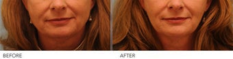 Botox Jaw (masseter) reduction before 319428