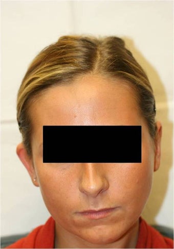Otoplasty-Uniltaeral (right ear) before 109837