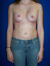 Pectus Excavatum Surgery after 121796