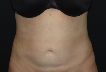 Tummy Liposuction after 229686