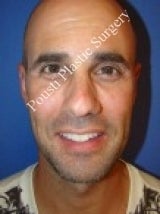 Ear Surgery (Otoplasty) after 579096