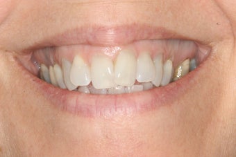 Invisalign and Whitening before 244073