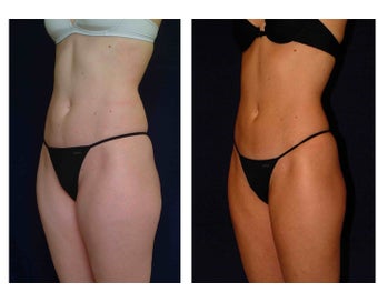 Liposuction before 286685