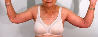 Brachioplasty after 524825