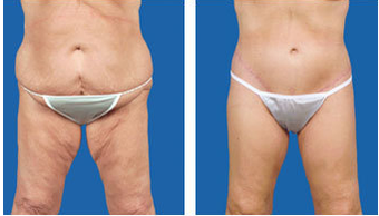 Lower body lift and tummy tuck post gastric bypass surgery - age 57 before 6813