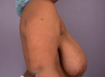 Breast Reduction before 285333