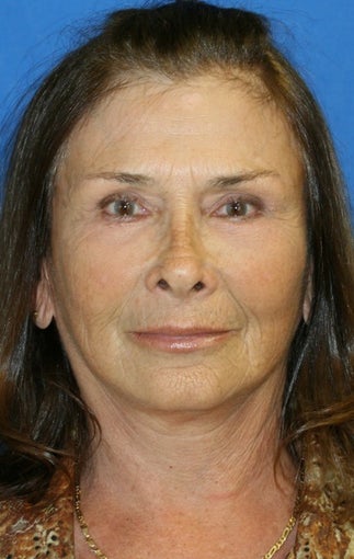 facelift after 264045