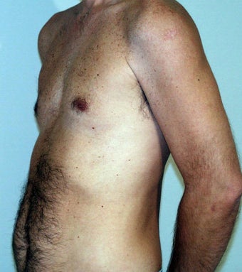 Male Chest Enhancement before 525477