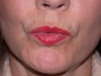 Before and After Botox to Upper Lip Lines after 53817