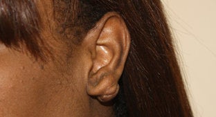 Earlobe Keloid before 494466
