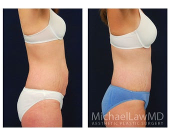 Abdominoplasty - Tummy Tuck 396105