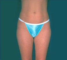 Smartlipo after 401662