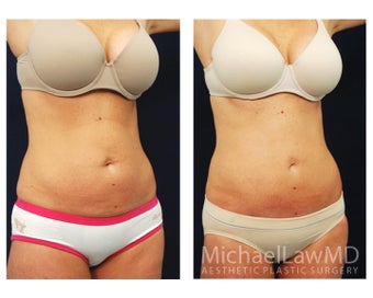 Abdominoplasty - Tummy Tuck after 396097