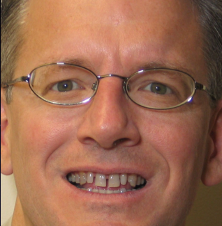 Porcelain Veneers before 366635