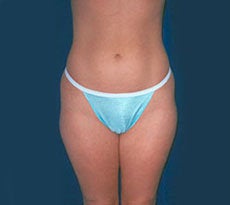 Smartlipo before 401662