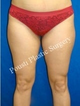 Liposuction before 633674