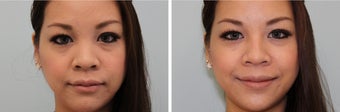 Nasal filler before 577824