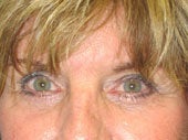 Brow Lift after 541474