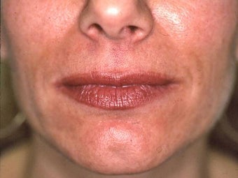 Lip Augmentation with Liquid Injectable Silicone before 157591