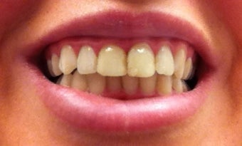 Zoom Whitening before 634706