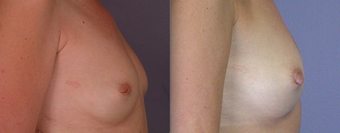 Nipple Surgery before 293273