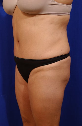 Abdominoplasty with liposculpture of abs, flanks, and waist after 82417