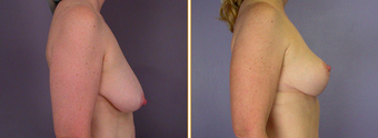 Breast Implants before 271089