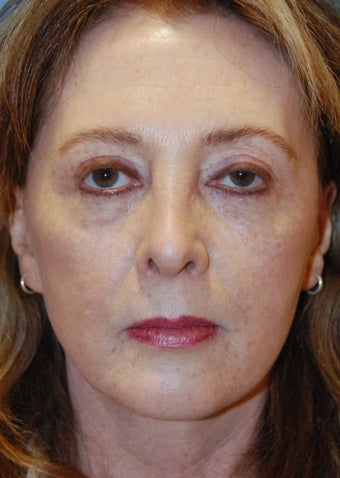 Fat transfer before 199382