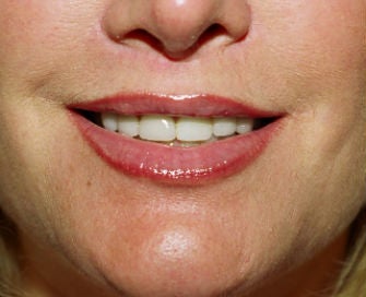 Lip lift, corner of lip lift, and filler in lips after 299914