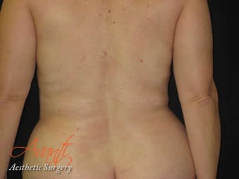 Vaser Lipo - Flanks after 376427