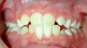 Teen Orthodontic Treatment (case #1AD) before 224689
