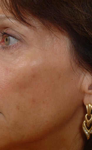 Pearl Laser Treatment before 102771