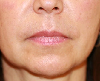 Anguloplasty before 299919