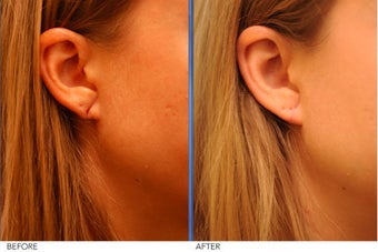 Earlobe Repair before 291675