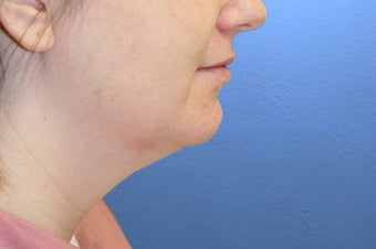 Neck Lift before 114169