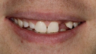 Porcelain Bridge and Veneer before 374681