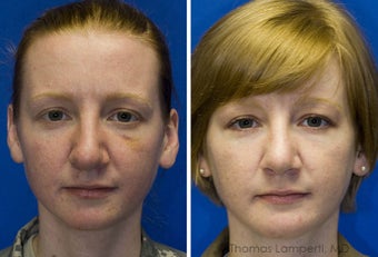 Revision Rhinoplasty, Chin Implantation, Mole Excision before 234398