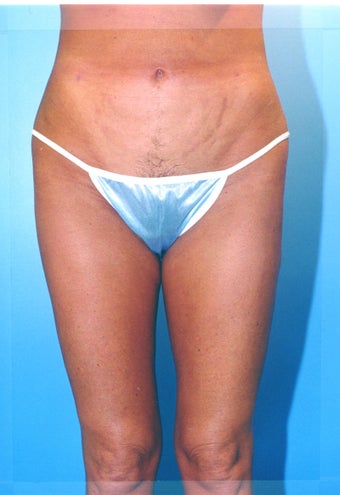 liposuction of thighs for women 583572