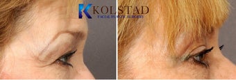 Botox before 519750