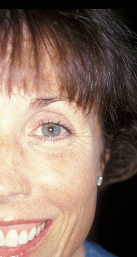 Botox before 469308