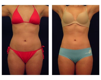 Liposuction before 286652