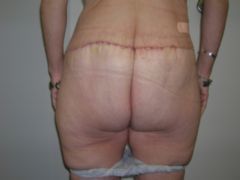 Gluteal Lift after 259012